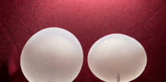 Krank durch Brustimplantate: Der Leidensweg einer 30jährigen